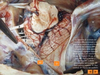 La apertura de la tienda del 
cerebelo (D), seccionada a lo 
largo de su inserción en el borde 
superior del peñasco (SP) y 
reflejada hacia atrás, permite 
observar el segmento tentorial 
del IV par (1) y sus relaciones. 1: 
IV par. 2: Vpar. 3: III par. 4: VI 
par. AB: Arteria basilar. C: 
Culmen. LC: Lóbulo 
cuadrangular del cerebelo. SP: 
Seno petroso superior. H: Hoz 
cerebral. D: Tienda del cerebelo. 
DSP
 