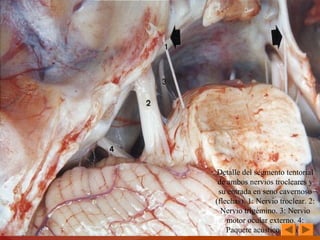 Detalle del segmento tentorial 
de ambos nervios trocleares y 
su entrada en seno cavernoso 
(flechas). 1: Nervio troclear. 2: 
Nervio trigémino. 3: Nervio 
motor ocular externo. 4: 
Paquete acústico-facial. 
 