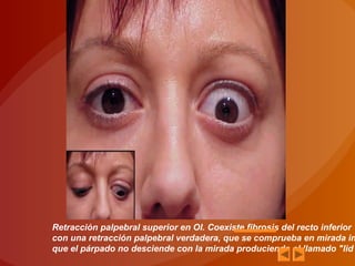 Retracción palpebral superior en OI. Coexiste fibrosis del recto inferior
con una retracción palpebral verdadera, que se comprueba en mirada in
que el párpado no desciende con la mirada produciendo el llamado "lid
 