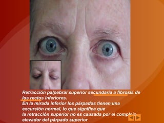Retracción palpebral superior secundaria a fibrosis de
los rectos inferiores.
En la mirada inferior los párpados tienen una
excursión normal, lo que significa que
la retracción superior no es causada por el complejo
elevador del párpado superior
 