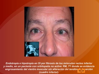 Endotropía e hipotropía en OI por fibrosis de los músculos rectos inferior
y medio, en un paciente con orbitopatía no activa. RM, T1 donde se evidencia
engrosamiento del vientre muscular sin alteración del tendón de inserción
(cuadro inferior).
 