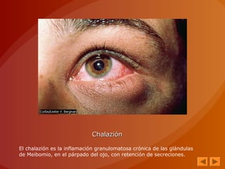ChalaziónChalazión
El chalazión es la inflamación granulomatosa crónica de las glándulas
de Meibomio, en el párpado del ojo, con retención de secreciones.
 