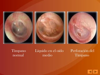 Tímpano
normal
Líquido en el oído
medio
Perforación del
Tímpano
 
