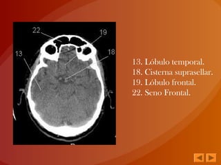 13. Lóbulo temporal.
18. Cisterna suprasellar.
19. Lóbulo frontal.
22. Seno Frontal.
 