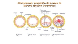 Aterosclerosis: progresión de la placa de
ateroma (sección transversal)
 