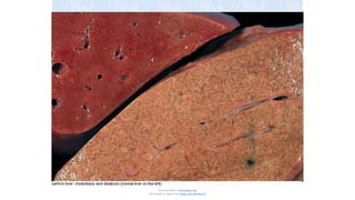 soffron livor: cholestosls ond steotosls (normalliver on lhe
left)
Document shared on www.docsity.com
Downloaded by: luiggi-solano (luiggi_solano@hotmail.es)
 