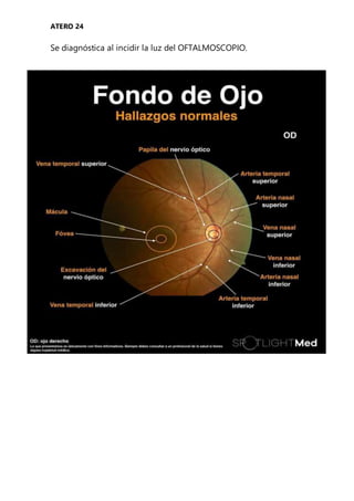 ATERO 24
Se diagnóstica al incidir la luz del OFTALMOSCOPIO.
 