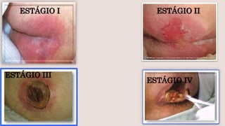 ESTÁGIO I ESTÁGIO II
ESTÁGIO III
ESTÁGIO IV
 