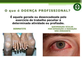 É aquela gerada ou desencadeada pelo
exercício de trabalho peculiar à
determinada atividade ou profissão.
DERMATITE
QUEIMADURA OCULAR
POR EXPOSIÇÃO A RADIAÇÃO
NÃO IONIZANTE
 