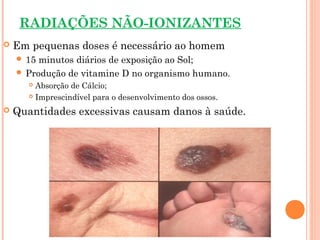 RADIAÇÕES NÃO-IONIZANTES
 Em pequenas doses é necessário ao homem
 15 minutos diários de exposição ao Sol;
 Produção de vitamine D no organismo humano.
 Absorção de Cálcio;
 Imprescindível para o desenvolvimento dos ossos.
 Quantidades excessivas causam danos à saúde.
 
