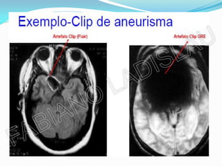 MASSAS FERROMAGNÉTICAS
 Implantes metálicos;
 Clip de aneurisma;
 Catéter;
 Clip cirúrgico;
 Implante coclear;
 Marca-passo;
 Prótese de material ferroso;
 