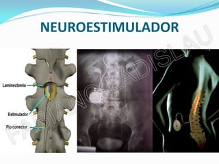 NEUROESTIMULADOR
 