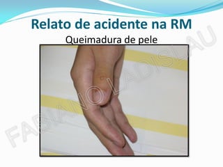 Relato de acidente na RM
     Queimadura de pele
 