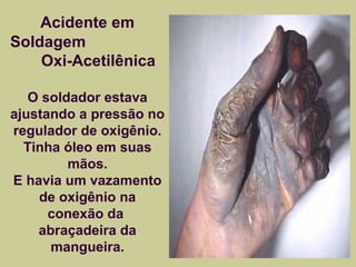 Acidente em 
Soldagem 
Oxi-Acetilênica 
O soldador estava 
ajustando a pressão no 
regulador de oxigênio. 
Tinha óleo em suas 
mãos. 
E havia um vazamento 
de oxigênio na 
conexão da 
abraçadeira da 
mangueira. 
 