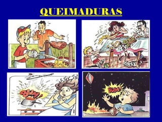 QUEIMADURAS
 