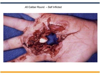 .40 Caliber Round – Self Inflicted
 