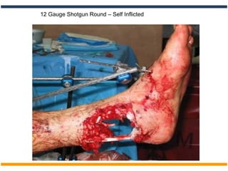 12 Gauge Shotgun Round – Self Inflicted
 