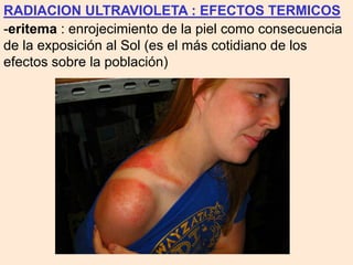 RADIACION ULTRAVIOLETA : EFECTOS TERMICOS
-eritema : enrojecimiento de la piel como consecuencia
de la exposición al Sol (es el más cotidiano de los
efectos sobre la población)
 