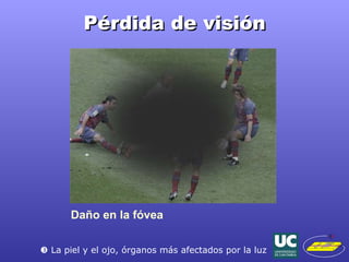 Pérdida de visión Daño en la fóvea    La piel y el ojo, órganos más afectados por la luz 