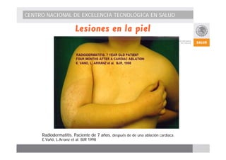 CENTRO NACIONAL DE EXCELENCIA TECNOLÓGICA EN SALUD 
Lesiones en la piel 
Radiodermatitis. Paciente de 7 años, después de de una ablación cardíaca. 
E.Vañó, L.Arranz et al. BJR 1998 
 