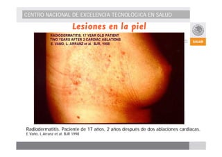 CENTRO NACIONAL DE EXCELENCIA TECNOLÓGICA EN SALUD 
Lesiones en la piel 
Radiodermatitis. Paciente de 17 años, 2 años después de dos ablaciones cardíacas. 
E.Vañó, L.Arranz et al. BJR 1998 
 