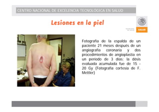 CENTRO NACIONAL DE EXCELENCIA TECNOLÓGICA EN SALUD 
Lesiones en la piel 
Fotografía de la espalda de un 
paciente 21 meses después de un 
angiografía coronaria y dos 
procedimientos de angioplastía en 
un período de 3 días; la dósis 
evaluada acumulada fue de 15 - 
20 Gy (Fotografía cortesía de F. 
Mettler) 
 