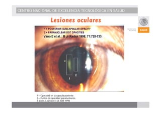 CENTRO NACIONAL DE EXCELENCIA TECNOLÓGICA EN SALUD 
Lesiones oculares 
1= Opacidad en la cápsula posterior. 
2= Puntos de opacidad paranucleares. 
E.Vano, L.Arranz et al. BJR 1998 
 