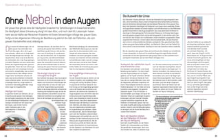 Wichtige Faktoren, die das Risiko der Ent-
wicklung des grauen Stars erhöhen und die
beeinflusst werden können, sind das Rau­
chen und UV-Strahlung. Es wurde bewie­
sen, dass bei Menschen, die 15 Zigaretten
pro Tag rauchen, die Wahrscheinlichkeit
drei Mal höher ist, dass sich bei ihnen der
graue Star entwickelt. Es ist auch bekannt,
dass ein leicht erhöhtes Risiko für die Ent-
wicklung des grauen Stars bei kurzsichtigen
und braunäugigen Menschen besteht.
Die einzige Lösung ist ein
chirurgischer Eingriff
Das Auftreten des grauen Stars bei jüngeren
Menschen ist oft mit Erkrankungen wie Di-
abetes und chronischen Entzündungen des
Auges verbunden, er kann sich aber auch
nach einer Augenverletzung entwickeln.
Bisher ist die einzige bekannte wirksame Be-
handlung die Kataraktchirurgie, bei der die
trübe natürliche Linse entfernt und an ihre
Stelle eine künstliche Linse eingefügt wird.
Dies ist die häufigste und wohl auch eine
der erfolgreichsten und
sichersten Auge-
noperationen.
Der beste
Zeitpunkt
für eine
Operation
ist weit-
gehend
von den
subjektiven
Problemen
des Patienten
und dessen
Ohne NebelindenAugen
Der graue Star gilt als eine der häufigsten Ursachen für Sehstörungen im Erwachsenenalter.
Die Häufigkeit dieser Erkrankung steigt mit dem Alter, und nach dem 65. Lebensjahr haben
mehr als die Hälfte der Menschen Probleme mit ihrem Sehvermögen infolge des grauen Stars.
Aufgrund der allgemeinen Alterung der Bevölkerung wächst die Zahl der Patienten, die vom
grauen Star betroffen sind, ständig an.
D
ie Ursache für Sehstörungen, die mit
dem grauen Star verbunden sind,
sind Störungen, die in der Augen­
linse auftreten, welche sich im Auge direkt
hinter der Regenbogenhaut befindet. Die
Hauptfunktion dieser Linse ist das Brechen
der Lichtstrahlen, die in das Auge gelangen,
und deren Projektion auf einen bestimmten
Bereich des Augenhintergrundes, genannt
der gelbe Fleck. Wenn die Linse trüb ist, ge-
langt das Licht noch schwieriger hindurch,
und es bricht unregelmäßig, was zu einem
verschwommenen oder nebligen Sehver-
mögen führt. Die Patienten nehmen oft
wahr, dass sie bei schlechten Lichtverhält­
nissen schlechter sehen. Sie können Farben
schwieriger erkennen, einige werden im
Sonnenlicht übermäßig geblendet, einige
sehen sogar ein doppeltes Bild.
Häufiger bei Frauen
Es gibt eine Anzahl von Faktoren, die zur
Entwicklung des grauen Stars beitragen,
die wichtigste Auswirkung hat aber sicher-
lich die erbbedingte Prädisposition. Etwas
häufiger entwickelt sich der graue Star
bei Frauen, was mit den hormo-
nellen Veränderungen in den
Wechseljahren in Verbindung
gebracht wird.
Die Standard-Intraokularlinsen, die bei der Kataraktchirurgie eingesetzt wer-
den, sind monofokal. Diese Linsen ermöglichen eine Sehschärfe auf Distanz,
also ein ähnliches Sehvermögen wie bei älteren Menschen ohne grauen Star.
Nach der Operation benötigen die Patienten zum Lesen eine Lesebrille. Moder-
ne Augenlinsen werden mit einem Injektor und mithilfe eines nur drei Millimeter
großen Einschnitts in das Auge eingeführt. Die Linse sieht beim Einführen in
das Auge in ihrer gebogenen Form wie eine Hülse aus, im Inneren des Auges
wird sie gerade ausgerichtet und korrekt eingesetzt. In den letzten zehn Jah-
ren hat sich der Einsatz von multifokalen Linsen erheblich ausgeweitet. Diese
sogenannten Premium-Linsen haben eine komplexe Optik, die das Brechen
des Lichts in unterschiedlichen Winkeln ermöglicht. Dies garantiert dem Pati-
enten eine gute Sehschärfe bei Weit- und Nahsicht. Wenn sich der Patient für
eine solche Linse entscheidet, benötigt er nach der Operation keine Lesebrille.
Bei der Operation des grauen Stars wird durchaus eine Vielzahl von künstlichen
Linsen verwendet. Im Zentrum für refraktive Augenchirurgie Morela okulisti
verwenden wir bei den Operationen des grauen Stars nur die qualitativ hoch-
wertigsten Implantate, die auf dem Markt verfügbar sind.
DieAuswahlderLinse
„Als Arzt hatte ich es vielleicht
ein bisschen einfacher, da ich
meine Krankheit gut kannte
und darüber mehr wusste
als normale Patienten. Ich
weiß, dass der Eingriff nichts
Besonderes ist, im Auge wird ein
kleiner Einschnitt gemacht, die
Linse wird eingefügt und das
Sehvermögen wird korrigiert,
aber er erfordert immer noch
extreme Präzision und eine
ruhige Hand. Ich habe den
Ärztinnen Dr. Vesna Morela, die
die Untersuchung vorgenommen
hat, und Dr. Kristina Mikek, die
den Eingriff durchgeführt hat,
völlig vertraut. Und obwohl mein
Herz vor dem Eingriff, das gebe
ich zu, schneller geschlagen
hat, ist die Angst vor einer
solchen Operation wirklich
ziemlich überflüssig.“
Marko Demšar, Arzt
Bedürfnissen abhängig. Die weitverbreitete,
aber fehlerhafte Überzeugung ist, dass der
graue Star für eine Operation reifen muss.
Gerade sehr aktive Patienten, die unter
Problemen wie einem geringeren visuellen
Kontrast und schlechter Sicht bei ­schlechten
Lichtverhältnissen leiden, was sehr unange-
nehm sein kann und sie bei ihren Tätigke-
iten einschränkt, können sich schon in den
frühen Stadien der Entwicklung des grauen
Stars für eine Operation entscheiden.
Eine sorgfältige Untersuchung
der Augen
Vor der Kataraktchirurgie ist, ähnlich wie bei
anderen Eingriffen, eine sorgfältige Unter-
suchung sehr wichtig. Bei dieser Untersu-
chung wird die Hornhaut überprüft, ihre
Krümmung und die Augenlänge gemessen
und so die Dioptrie der künstlichen Linse
bestimmt, die während der Operation ins
Auge eingesetzt wird. Wir führen stets eine
Untersuchung des Augenhintergrundes
durch, was notwendig ist, damit wir sicher-
gehen können, dass keine degenerativen
Veränderungen der Netzhaut zu erkennen
sind. Patienten, die neben dem grauen
Star auch degenerative Veränderungen
im Augenhintergrund aufweisen, sollten
sich bewusst sein, dass ihr Sehvermögen
auch nach der Operation aufgrund dieser
Veränderungen nicht perfekt sein wird. Ein
wichtiger Teil der Untersuchung ist auch die
Messung des Augeninnendrucks. Bei der
Untersuchung erhält der Patient alle rele-
vanten Informationen im Zusammenhang
mit der Operation, wir informieren ihn auch
über mögliche Komplikationen.
Austausch der natürlichen durch
eine künstliche Linse
Die Operation wird ambulant unter lokaler
Betäubung durchgeführt. Vor dem Eingriff
wird der Augenvordergrund mit Tropfen
gelähmt und die Pupille verbreitert. Mithilfe
eines kleinen Schnitts am Rande der Horn­
haut, der nur wenige Millimeter misst, wird
die degenerativ veränderte Augenlinse mit
einem Ultraschallgerät zerkleinert und ansc-
hließend absorbiert. An ihre Stelle wird eine
künstliche Linse eingesetzt. Die gesamte
Operation dauert 15 bis 30 Minuten, in
Ausnahmefällen auch länger. Die Dauer der
Operation hängt von zugehörigen Augener-
krankungen und dem Grad der Verände-
rung der natürlichen Augenlinse ab. Bei
Patienten mit bilateralem grauen Star kön-
nen beide Eingriffe gleichzeitig durchgeführt
werden. Dadurch wird die Behandlungsdau-
er verringert und die Anzahl der Besuche in
unserer Klinik reduziert.
Nach der Operation stehen
wir den Patienten 24 Stunden
am Tag zur Verfügung
Nach dem Eingriff tröpfelt sich der Patient
Tropfen mit Corticosteroiden und Antibio-
tika gemäß den Anweisungen, die er vom
Arzt erhalten hat, selbst ins operierte Auge
Mit Ultraschall zerkleinern wir den getrübten grauen Star und
absorbieren dessen Inhalt. Eine neue, künstliche Intraokularlinse in der Linsenkapsel.
Für eine kostenlose und unverbindliche
Untersuchung der Augen sowie eine
Beratung mit einem Arzt über
die Möglichkeiten einer
Operation des grauen
Stars rufen Sie bitte
das Zentrum Morela
okulisti unter der
Telefonnummer
+386 1 51 02
340 an. Die
Untersuchung
kann in Ljubljana
oder Bled
durchgeführt
werden.
ein. Die erste Untersuchung wird einen Tag
nach der Operation durchgeführt, darauf­
hin wird der Patient in der Regel nach 1-2
Wochen kontrolliert. Die Untersuchung, in
deren Rahmen eine Brille für die Nahsicht
verschrieben wird, wird in der Regel nach
einem Monat durchgeführt. Nach Wunsch
des Patienten kann er alle Kontrollen, außer
der ersten, auch bei seinem Augenarzt
durchführen. Wenn der Patient nach der
Operation irgendwelche Beschwerden oder
Fragen hat, stehen wir ihm per Telefon 24
Stunden am Tag zur Verfügung.
Intraokularlinse
34 35
Operation des grauen Stars
 