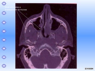 Nível hidro-aéreo e
Espessamento da mucosa

 