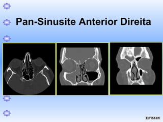 Pan-Sinusite Anterior Direita

 