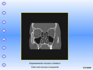 Espessamento mucoso a direita e
Cisto sub-mucoso à esquerda

 