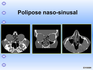 Polipose naso-sinusal

 