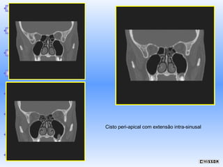 Cisto peri-apical com extensão intra-sinusal

 