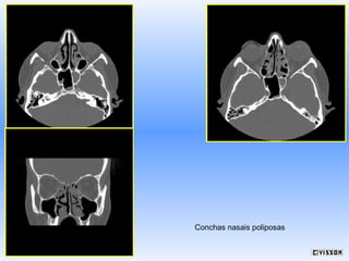 Conchas nasais poliposas

 