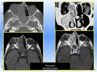 Mucocele
Sinusite fúngica

 