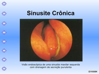 Sinusite Crônica

Visão endoscópica de uma sinusite maxilar esquerda
com drenagem de secreção purulenta

 