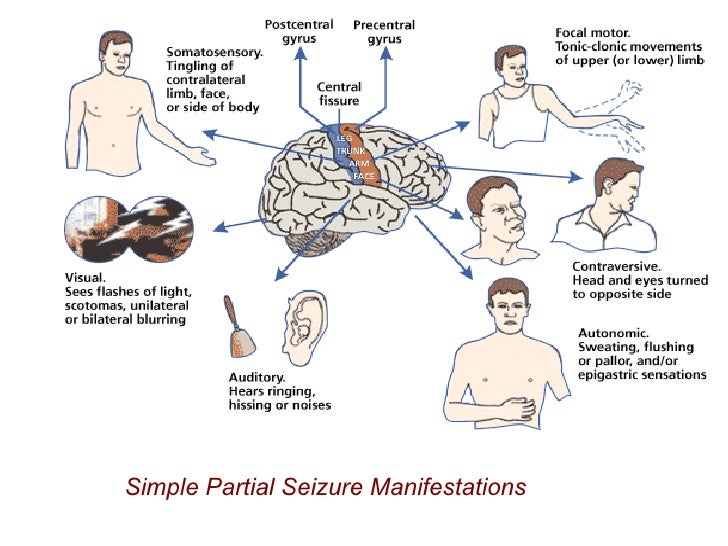 Seizure Deutsch Seizure Deutsch