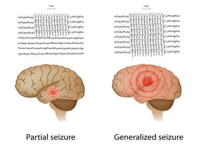 Seizure PPTX