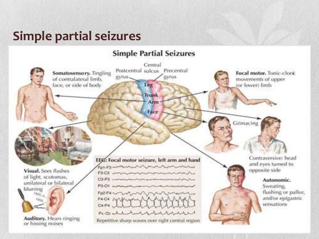 Que Es Seizure Disorder En Espanol – HEMBQ