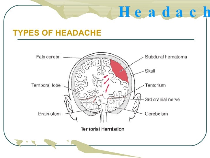 types of headaches chart