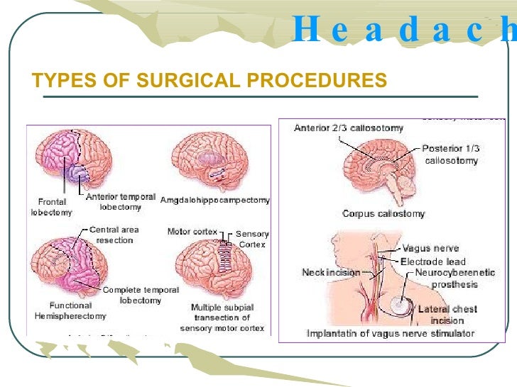 What Are The Different Types Of Surgeries