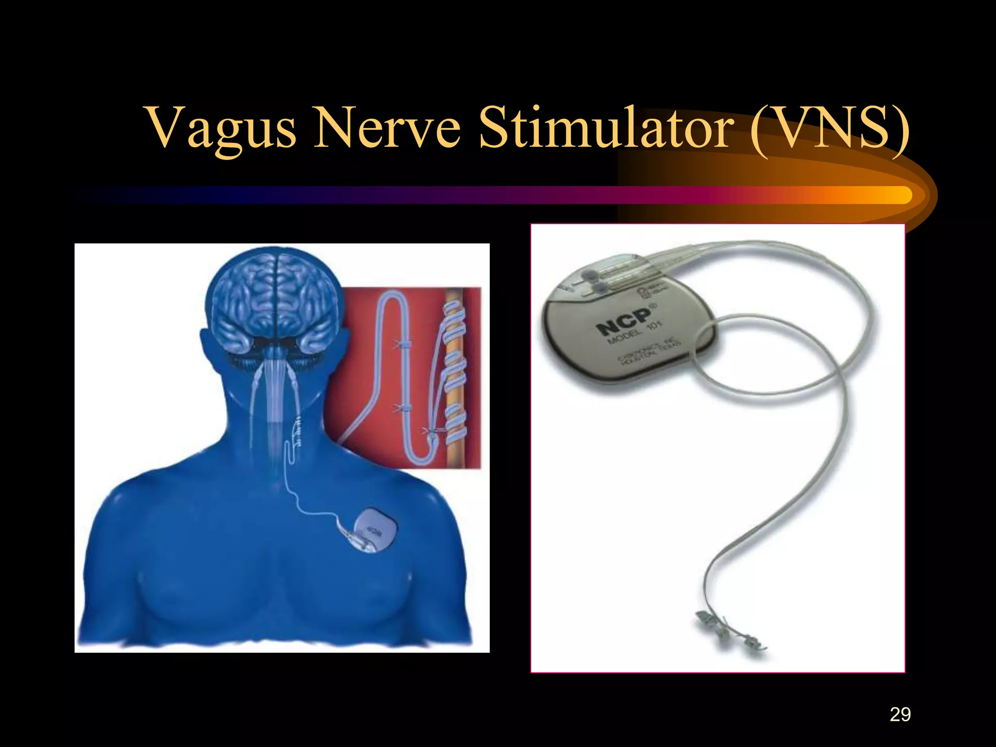 29
Vagus Nerve Stimulator (VNS)
 