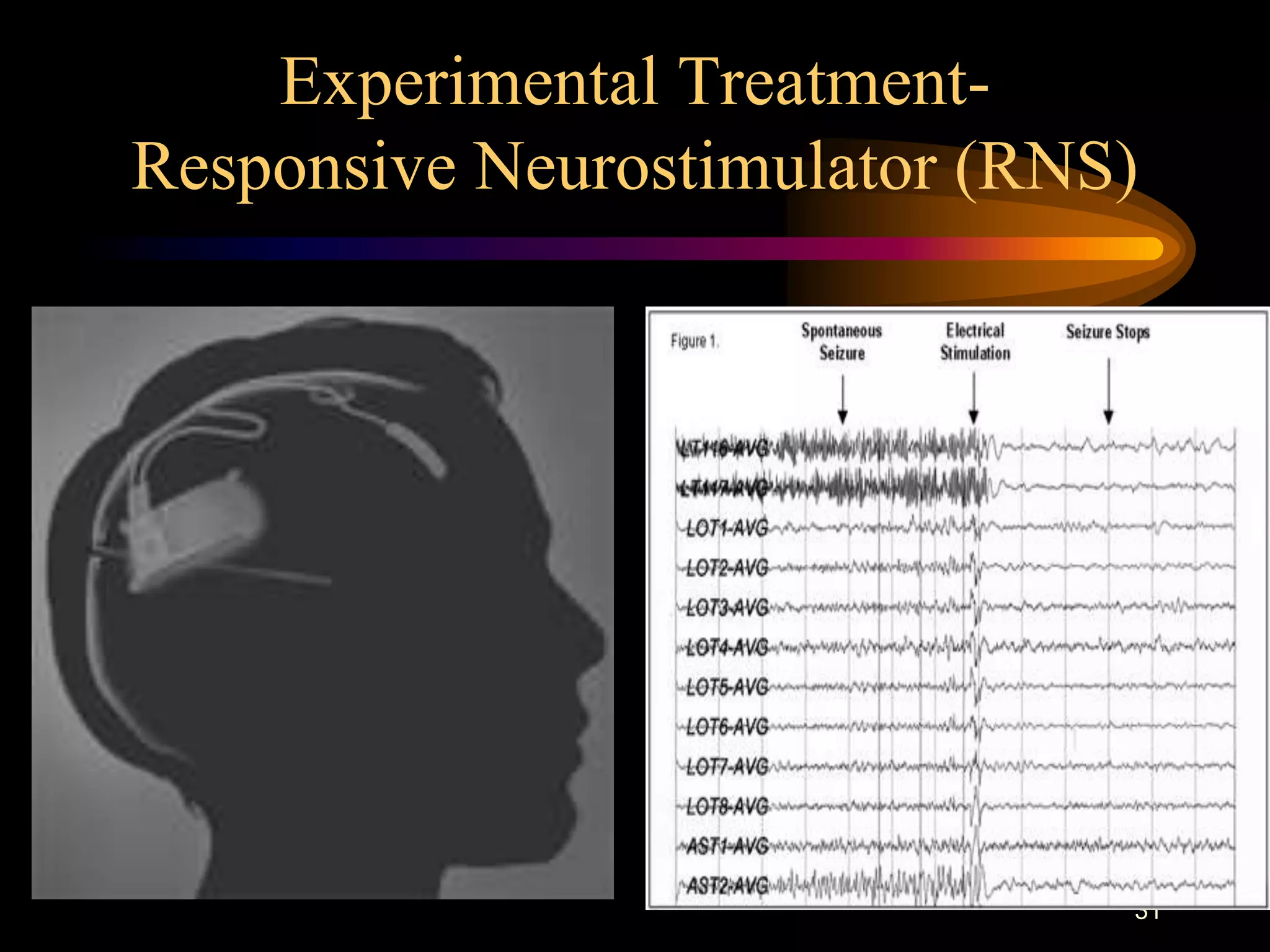 31
Experimental Treatment-
Responsive Neurostimulator (RNS)
 
