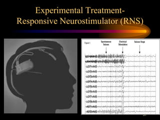 31
Experimental Treatment-
Responsive Neurostimulator (RNS)
 