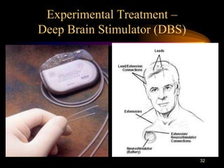 32
Experimental Treatment –
Deep Brain Stimulator (DBS)
 