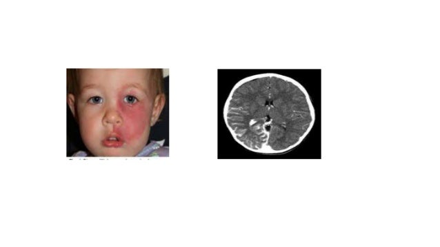 after seizure behavior seizures in children after seizure behavior seizures in children