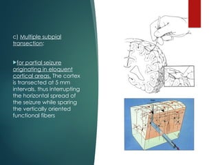 Subpial Injection Seizure Surgery : Neurosurgical perspective | PPTX