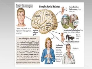 Seizures in children | PPTX