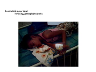 Generalized motor onset
stiffening/jerking/tonic clonic
 