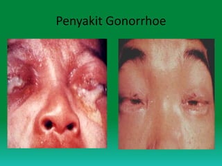 Penyakit Gonorrhoe
 